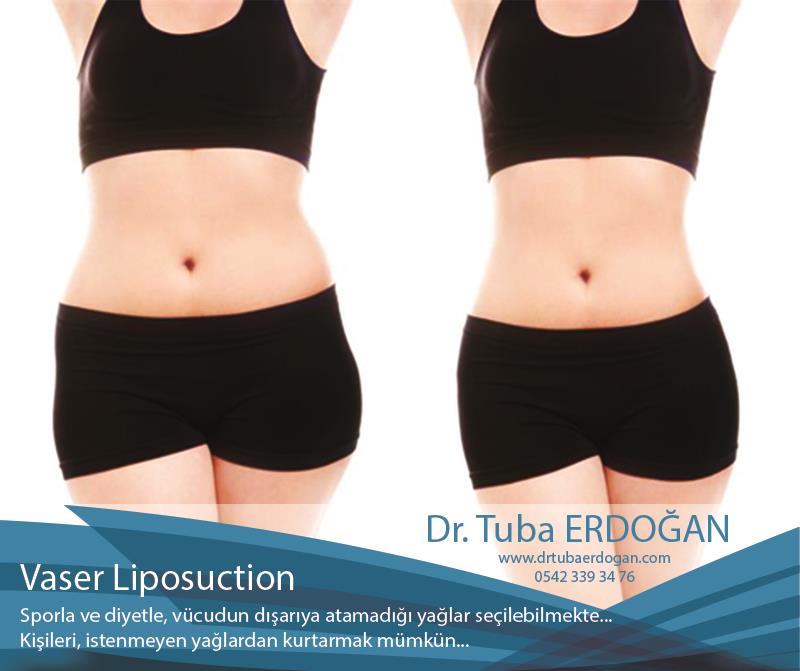 Vaser Liposuction Avantajları